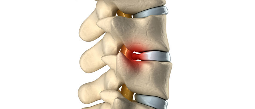 herniated disc