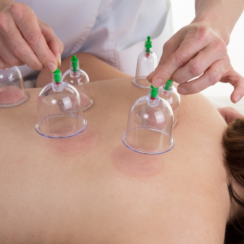 physical-therapy-clinic-cupping-south-toledo-pt-toledo-oh